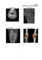 Diplomdarbs 'Datortomogrāfijas izmeklējuma kvalitātes izvērtējums ceļa locītavas traumu gadīj', 44.