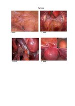 Referāts 'Endometrioze', 11.