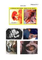 Referāts 'Aborts', 38.