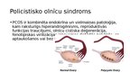 Prezentācija 'Policistisko olnīcu sindroms', 2.