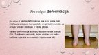 Prezentācija 'Kāju un pēdu deformācijas. Ārstēšana, fizioterapija', 6.