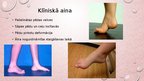 Prezentācija 'Kāju un pēdu deformācijas. Ārstēšana, fizioterapija', 14.