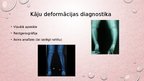 Prezentācija 'Kāju un pēdu deformācijas. Ārstēšana, fizioterapija', 34.