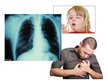Prezentācija 'Bronhiālā astma', 11.