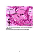 Konspekts 'Plaušu venozā hiperēmija (plaušu būnā indurācija)', 11.