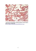 Konspekts 'Plaušu venozā hiperēmija (plaušu būnā indurācija)', 12.