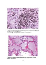 Konspekts 'Plaušu venozā hiperēmija (plaušu būnā indurācija)', 13.