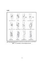 Referāts 'Femur diafizārie lūzumi', 15.