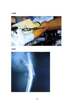 Referāts 'Femur diafizārie lūzumi', 16.