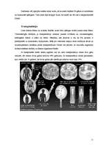 Referāts 'Fankoni anēmija', 11.