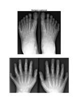 Konspekts 'Ģenētiskās slimības. Polidaktīlija', 3.