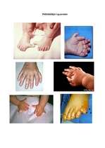 Konspekts 'Ģenētiskās slimības. Polidaktīlija', 5.