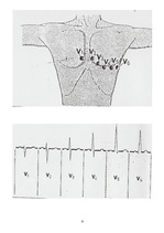Konspekts 'Miokarda bojājuma bioķīmiskie marķieri', 6.