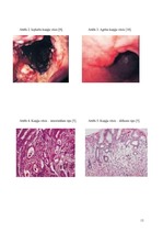 Referāts 'Kuņģa vēzis', 13.