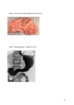 Referāts 'Kuņģa vēzis', 14.