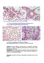Konspekts 'Plaušu venozā pilnasinība (plaušu brūnā indurācija)', 7.