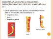 Prezentācija 'Ortozēšanas iespējas apakšstilba kaulu osteomielīta izraisīto ortopēdisko traucē', 8.