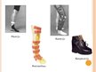 Prezentācija 'Ortozēšanas iespējas apakšstilba kaulu osteomielīta izraisīto ortopēdisko traucē', 10.