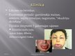 Prezentācija 'Hereditārā angioedēma', 6.