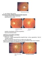 Konspekts 'Glaukoma', 7.