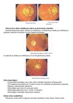 Konspekts 'Glaukoma', 8.