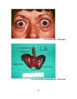 Referāts 'Greivsa slimība', 22.