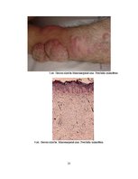 Referāts 'Greivsa slimība', 23.