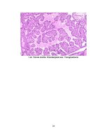 Referāts 'Greivsa slimība', 24.