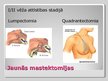 Prezentācija 'Mastektomija (no vēstures līdz mūsdienām)', 11.
