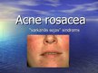 Prezentācija 'Acne Rosacea', 1.
