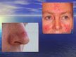Prezentācija 'Acne Rosacea', 3.