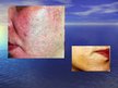 Prezentācija 'Acne Rosacea', 4.