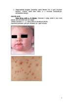 Konspekts 'Bērnu infekcijas slimības, kas noris ar izsitumiem', 3.