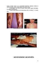 Konspekts 'Bērnu infekcijas slimības, kas noris ar izsitumiem', 12.