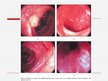 Prezentācija 'Čūlainais kolīts, Krona slimība', 11.