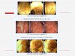 Prezentācija 'Čūlainais kolīts, Krona slimība', 29.