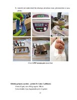 Referāts 'Trombocītiem bagātinātas plazmas un fibrīna pielietošana diabētiskās čūlas aprūp', 21.