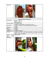 Referāts 'Trombocītiem bagātinātas plazmas un fibrīna pielietošana diabētiskās čūlas aprūp', 51.