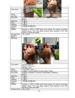 Referāts 'Trombocītiem bagātinātas plazmas un fibrīna pielietošana diabētiskās čūlas aprūp', 52.