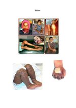 Konspekts 'Hemofīlija', 5.