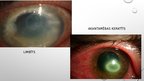Prezentācija 'Akantamēbas keratīts', 8.