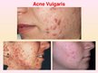 Prezentācija 'Patstāvīgais darbs ādas slimībās. Acne vulgaris', 3.