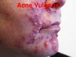 Prezentācija 'Patstāvīgais darbs ādas slimībās. Acne vulgaris', 4.