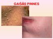 Prezentācija 'Patstāvīgais darbs ādas slimībās. Acne vulgaris', 12.