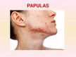 Prezentācija 'Patstāvīgais darbs ādas slimībās. Acne vulgaris', 13.