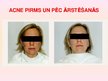 Prezentācija 'Patstāvīgais darbs ādas slimībās. Acne vulgaris', 28.