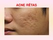 Prezentācija 'Patstāvīgais darbs ādas slimībās. Acne vulgaris', 29.