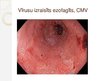 Prezentācija 'Nerefluksa ezofagīti', 17.