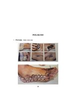 Referāts 'Botulīna toksīna injekcijas kā hiperhidrozes ārstēšanas metode', 38.