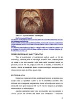 Referāts 'Hipofīzes audzēji', 16.